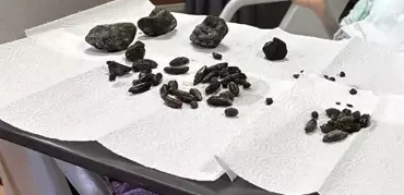 Ameliyat ile mideden çıkarıldılar