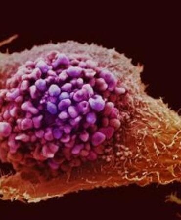 Prostat kanseri taramasında devrim: Yeni test alternatifi!